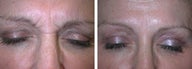 Botox