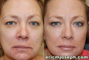 Non-Surgical Facial Rejuvenation with BOTOX Cosmetic and Silikon-1000