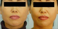 Botox Jaw Reduction