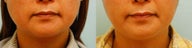 Botox Jaw Reduction