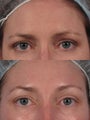 Botox to glabella and "crow's lines"