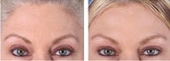 Botox Cosmetic