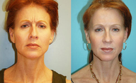 Botox