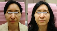 Botox Cosmetic