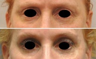 Botox around eyes