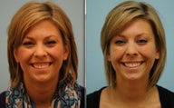 Gummy Smile Correction using Botox