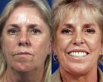 Botox with Facelift, Rhinoplasty, Laser Resurfacing, and Dermal Fillers