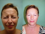 Botox in the corrugator muscle.