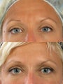 Botox for frown lines and crow's feet