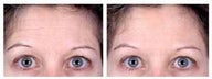 Botox for Forehead Wrinkles