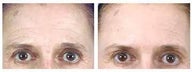 Botox and Browlift