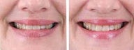 Botox for wrinkles