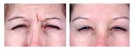 Botox for expression lines