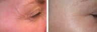 Botox