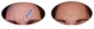 Botox