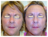 Botox