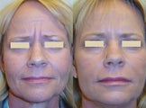 Botox and Fillers