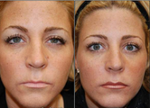 Liquid Face Lift with BOTOX Cosmetic and Silikon-1000