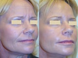 Botox and Fillers