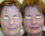 Botox and Restylane