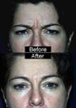 Botox