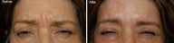 Botox treatment for brow wrinkles