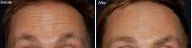 Botox for forehead lines
