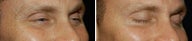 Botox for Crows Feet