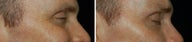 Botox for Crows Feet
