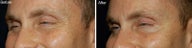 Botox for Crows Feet