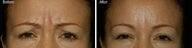 Botox for brow lines