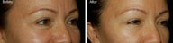 Botox for Crows Feet