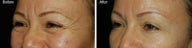 Botox for Crows Feet