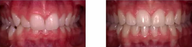 Over-bite corrected with braces