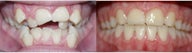 Before and after orthodontic treatment