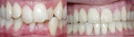 Before and after orthodontic treatment