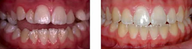 Braces - Open bite