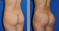 Brazilian Butt Lift