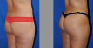 Brazilian Butt Lift