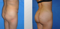 Brazilian Butt Lift (Fat Transfer)