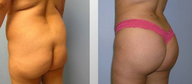 Brazilian Butt Lift (Fat Transfer)
