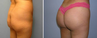 Brazilian Butt Lift (Fat Transfer)