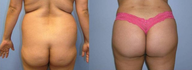 Brazilian Butt Lift (Fat Transfer)