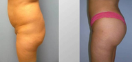 Brazilian Butt Lift (Fat Transfer)