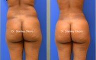 Brazilian Buttock Lift