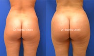 Brazilian Buttock Lift