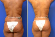 Brazilian Buttock Lift