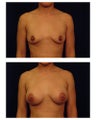 Breast Augmentation