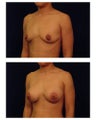 Breast Augmentation