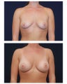 Breast Augmentation